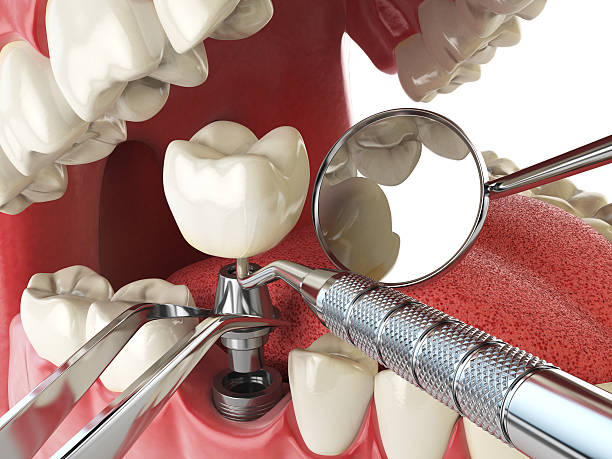 Best Emergency Root Canal Treatment in Akron, IN